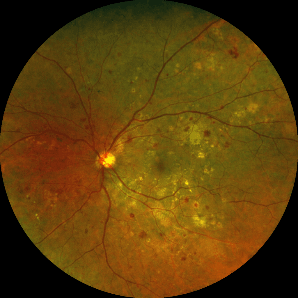 당뇨망막병증 비교