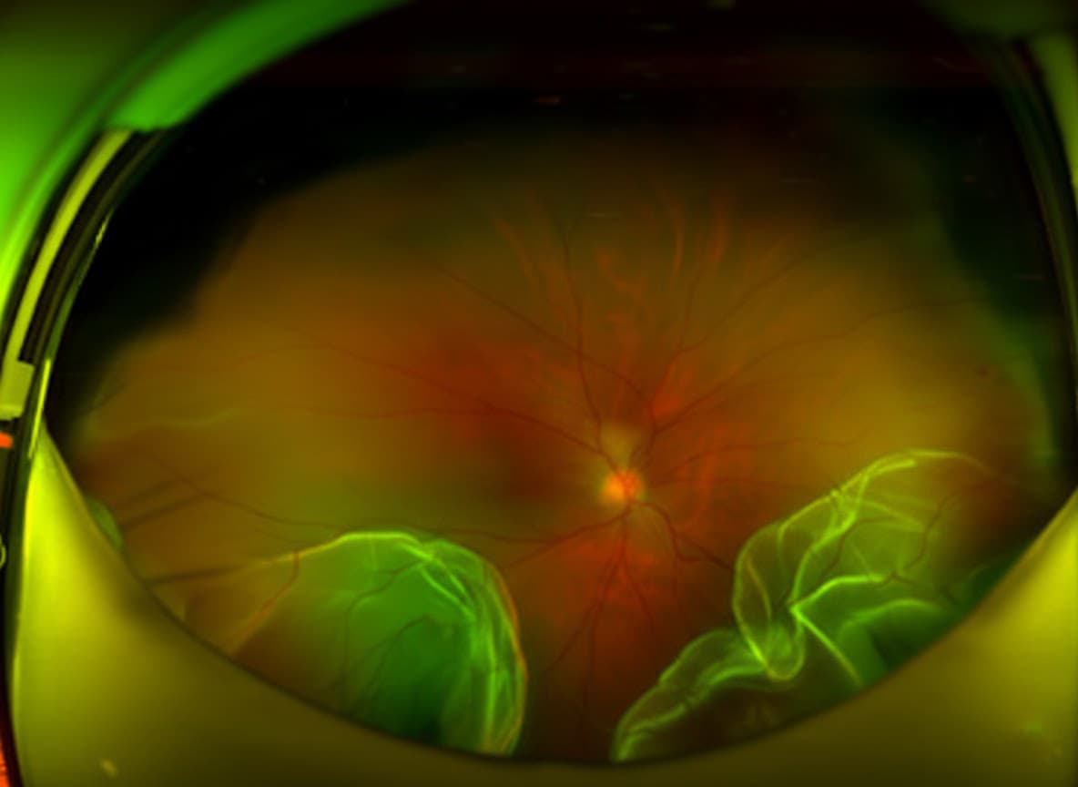 망막박리 진행 모식도