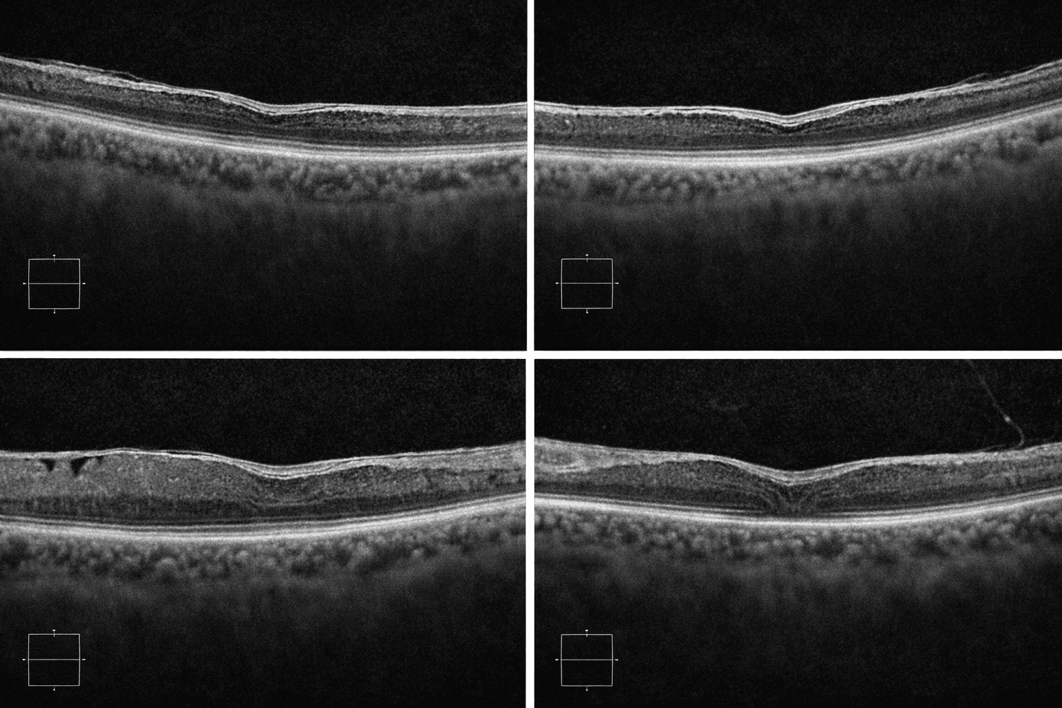 망막전막 모식도