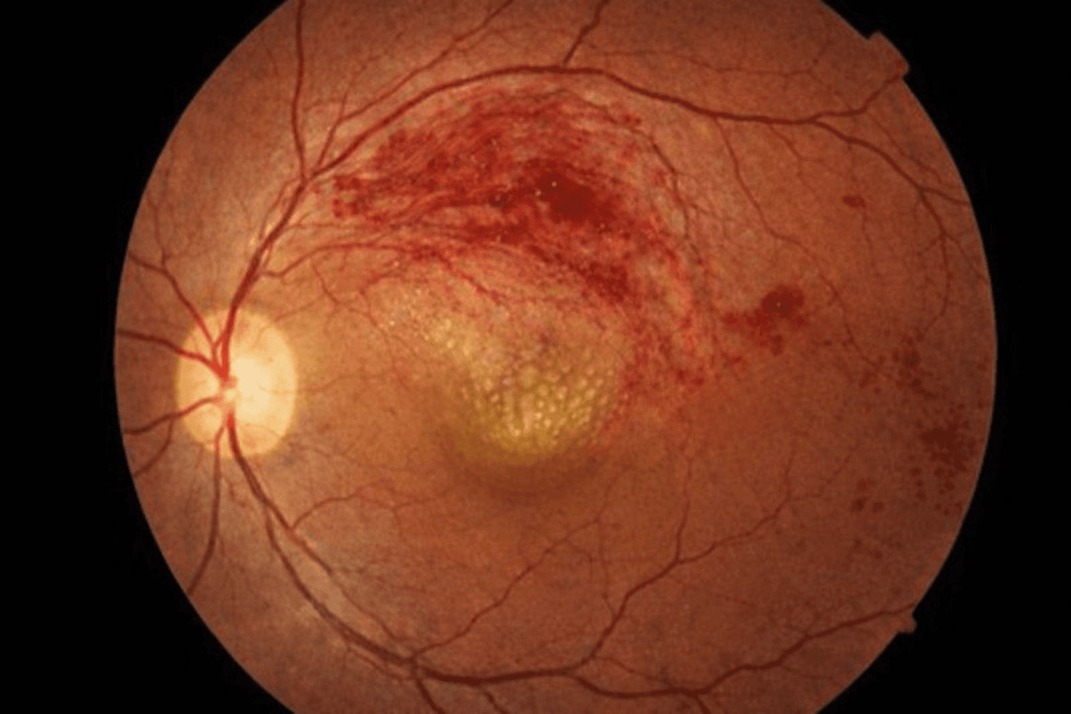 망막정맥폐쇄 1