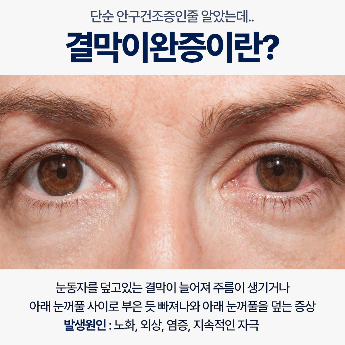 Conjunctivochalasis Symptom