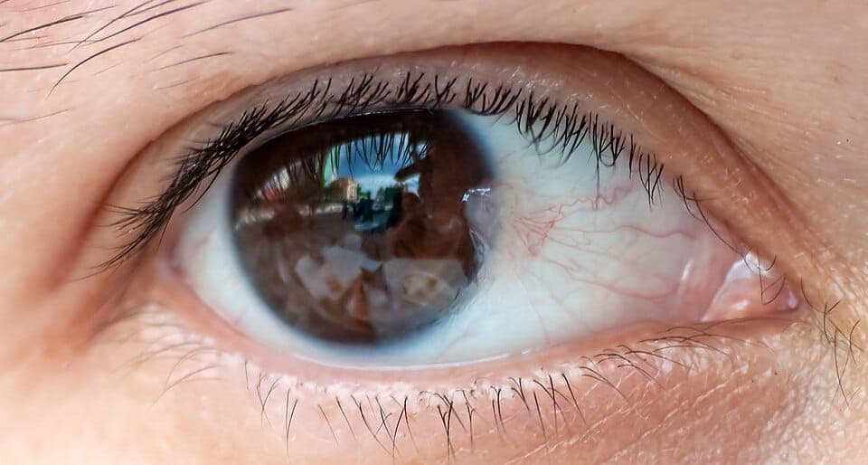 Pterygium Symptom with Labels