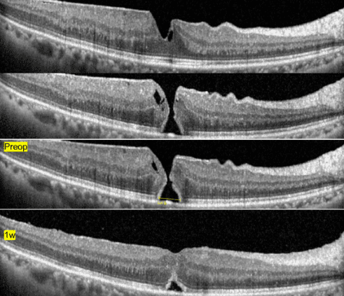 황반원공 OCT 소견