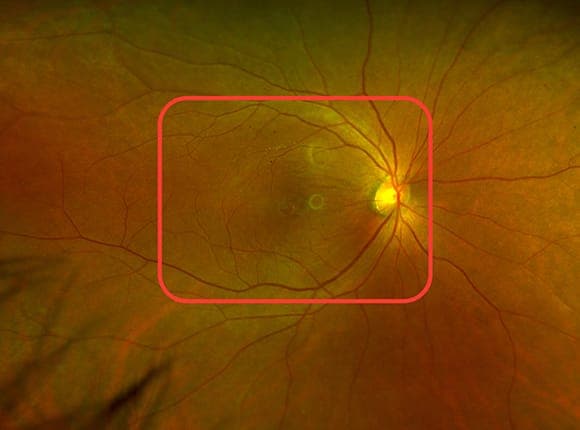 황반원공 발생 기전