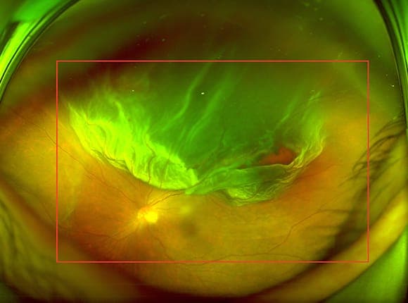 망막박리 진행 모식도