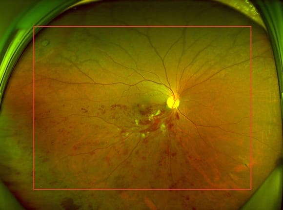 망막정맥폐쇄 발생 기전