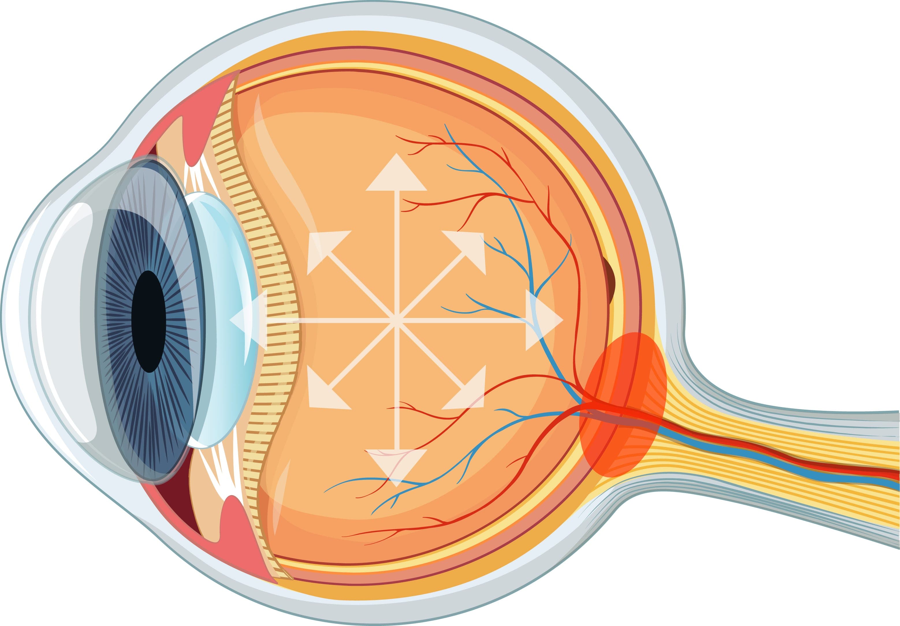 백내장 합병증 (녹내장 등)