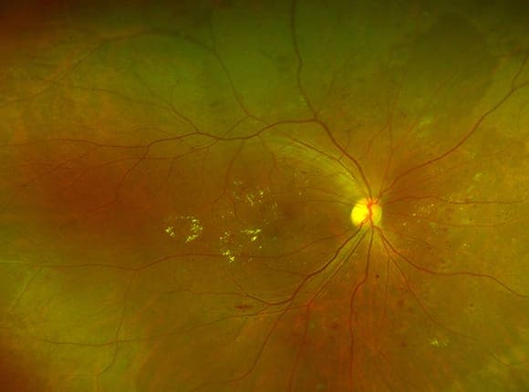 당뇨망막병증 비교